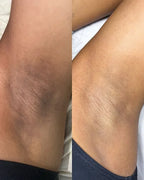 🔥CLAREIA MANCHAS ESCURAS NO CORPO: ROSTO, AXILAS, BUNDAS, VIRILHAS E UNIFORMIZE SUA PELE EM 14 DIAS😍