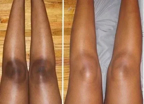 🔥CLAREIA MANCHAS ESCURAS NO CORPO: ROSTO, AXILAS, BUNDAS, VIRILHAS E UNIFORMIZE SUA PELE EM 14 DIAS😍